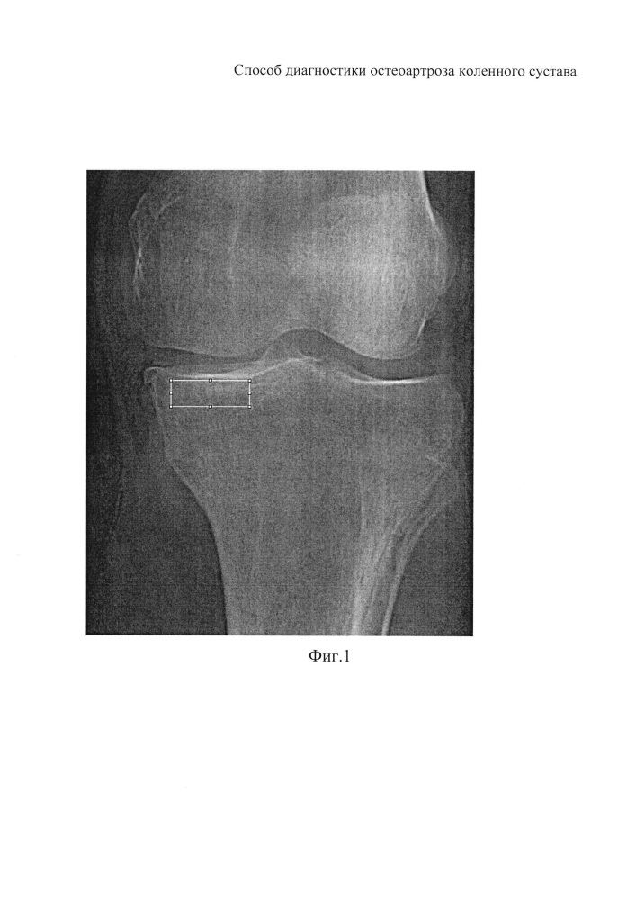 Способ диагностики остеоартроза коленного сустава (патент 2644541)