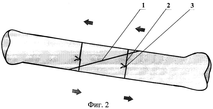 Способ фиксации отломков трубчатых костей с косыми и винтообразными переломами (патент 2331379)