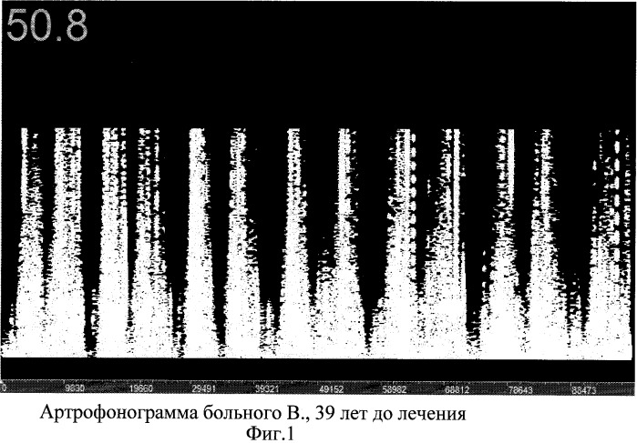 Способ лечения посттравматического деформирующего остеоартроза (патент 2384352)