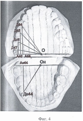 Способ биометрической ортодонтической диагностики на моделях челюстей (патент 2446739)