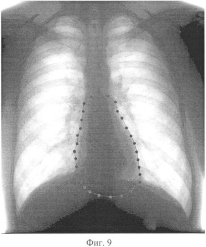 Способ автоматического определения размеров и положения сердца пациента по флюорографическим снимкам (патент 2372844)