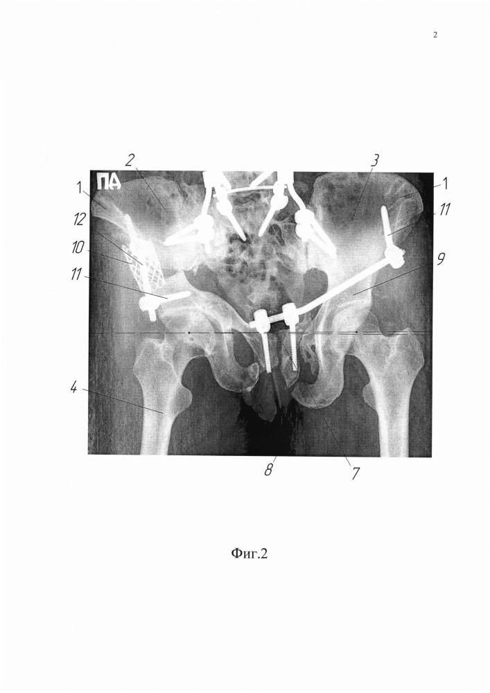 Способ реконструкции таза при сложных посттравматических деформациях (патент 2637283)