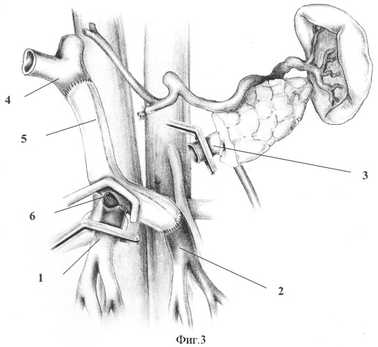 Способ панкреатодуоденальной резекции при местнораспространенном раке периампулярной области с обширной опухолевой инвазией магистральных вен мезентерико-портальной системы и наличием двух основных стволов верхней брыжеечной вены (патент 2317018)
