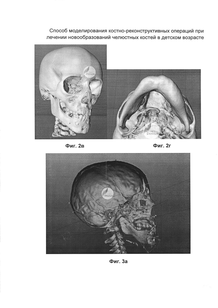 Способ моделирования костно-реконструктивных операций при лечении новообразований челюстных костей в детском возрасте (патент 2607651)