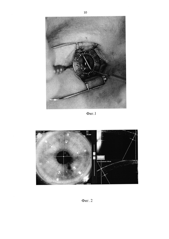 Способ двухэтапной коррекции роговичного миопического астигматизма с учетом циклоторсии с использованием фемтосекундного лазера у пациентов с тонкой роговицей (патент 2630036)
