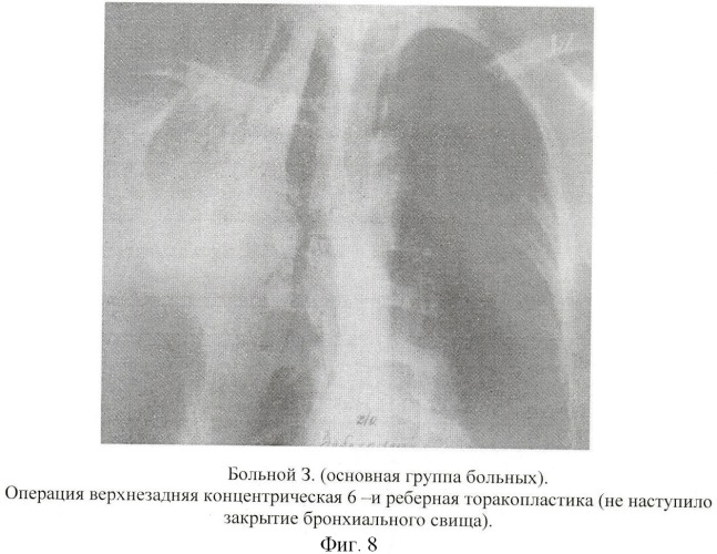 Способ хирургического лечения туберкулеза легких (патент 2417762)