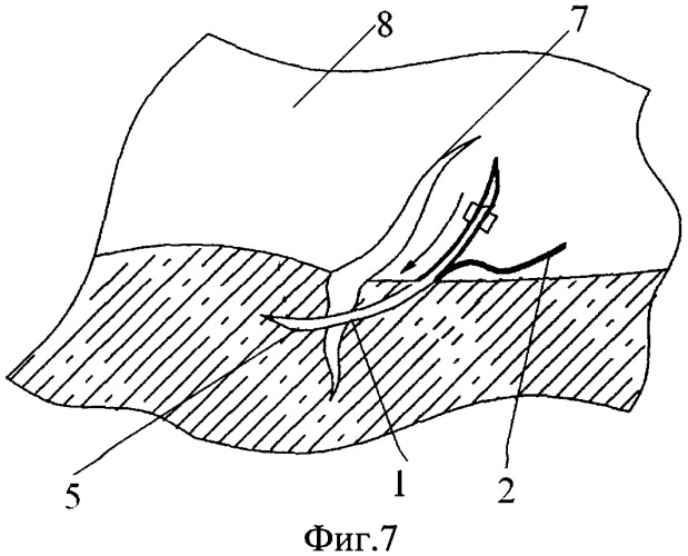 Одноразовая хирургическая игла (патент 2460477)