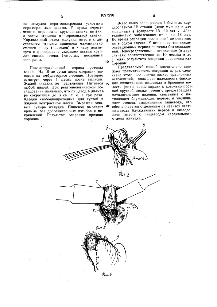 Способ лечения кардиоспазма 1у стадии (патент 1097298)