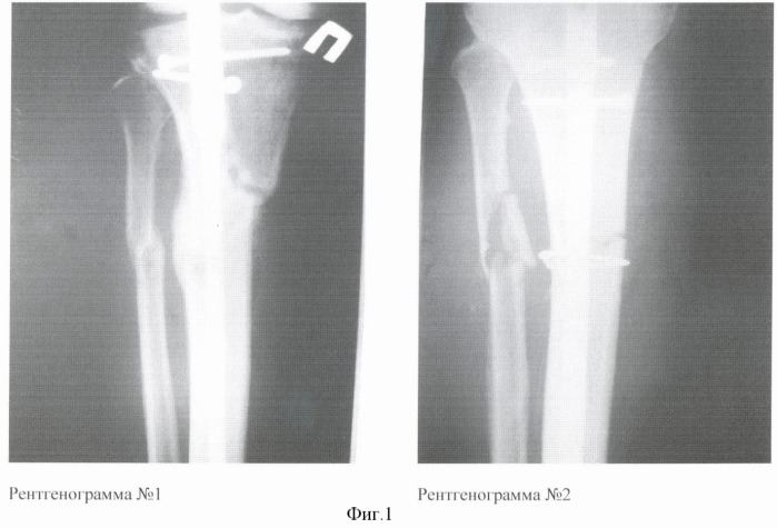 Способ лечения многооскольчатых и множественных переломов длинных трубчатых костей (патент 2370227)