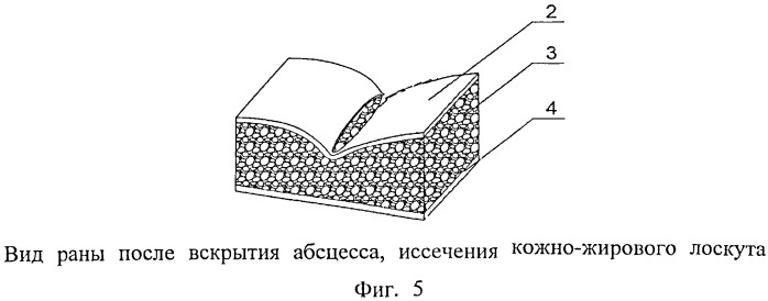 Одноэтапный метод хирургического лечения эпителиального копчикового хода (патент 2499562)