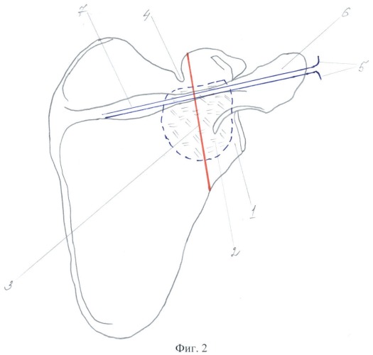 Способ лечения доброкачественных опухолей и опухолеподобных поражений шейки лопатки у детей (патент 2407471)