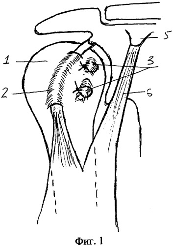 Способ хирургического лечения привычного вывиха плеча (патент 2283629)