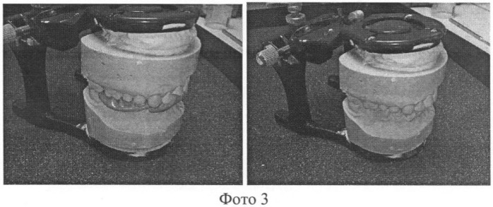 Способ снятия оттисков с использованием индивидуальной ложки при протезировании ортопедическими конструкциями (патент 2458654)