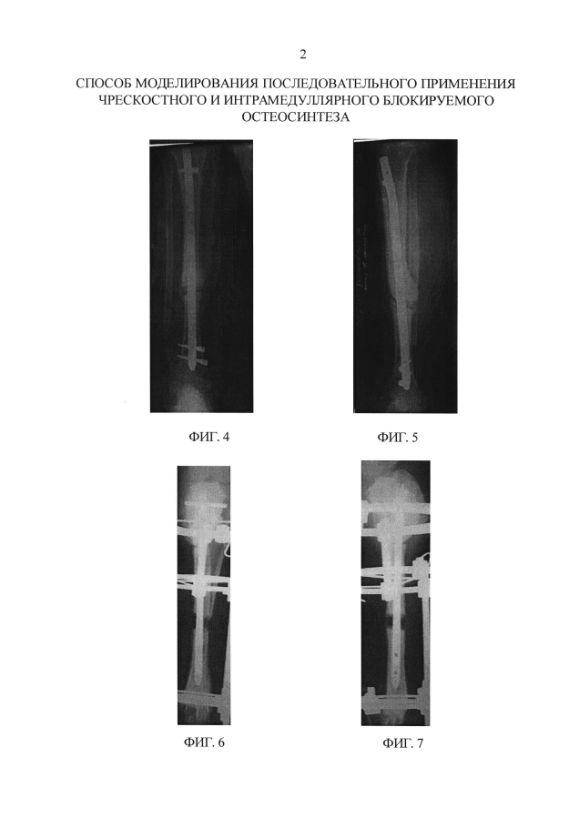 Способ моделирования последовательного применения чрескостного и интрамедуллярного блокируемого остеосинтеза (патент 2593583)