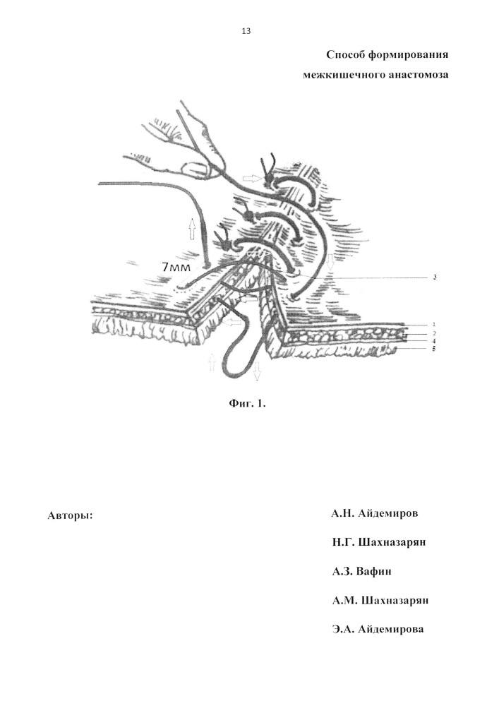 Способ формирования межкишечного анастомоза (патент 2663648)