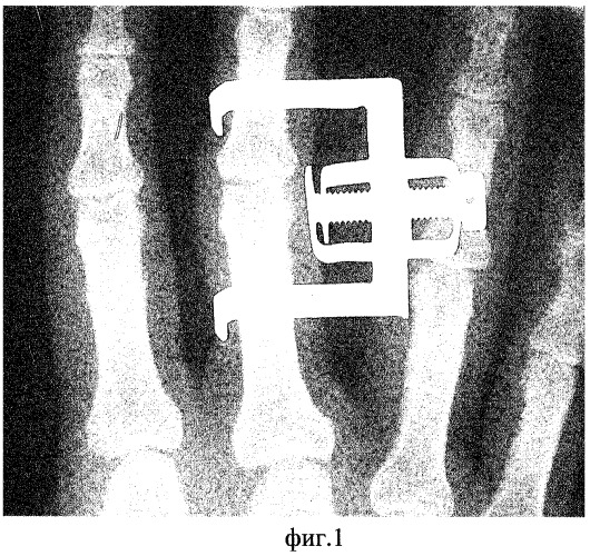 Устройство для рентгенофункциональной диагностики повреждений коллатеральных связок межфаланговых суставов пальцев кисти (патент 2306861)