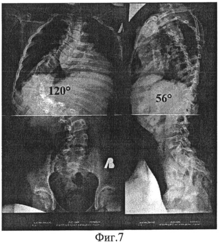 Способ коррекции деформации позвоночника (патент 2506919)