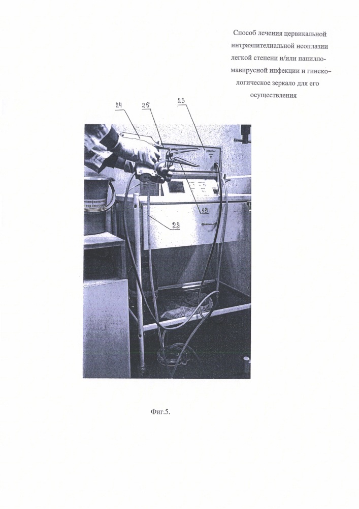 Способ лечения цервикальной интраэпителиальной неоплазии легкой степени и/или папилломавирусной инфекции и гинекологическое зеркало для его осуществления (патент 2623449)