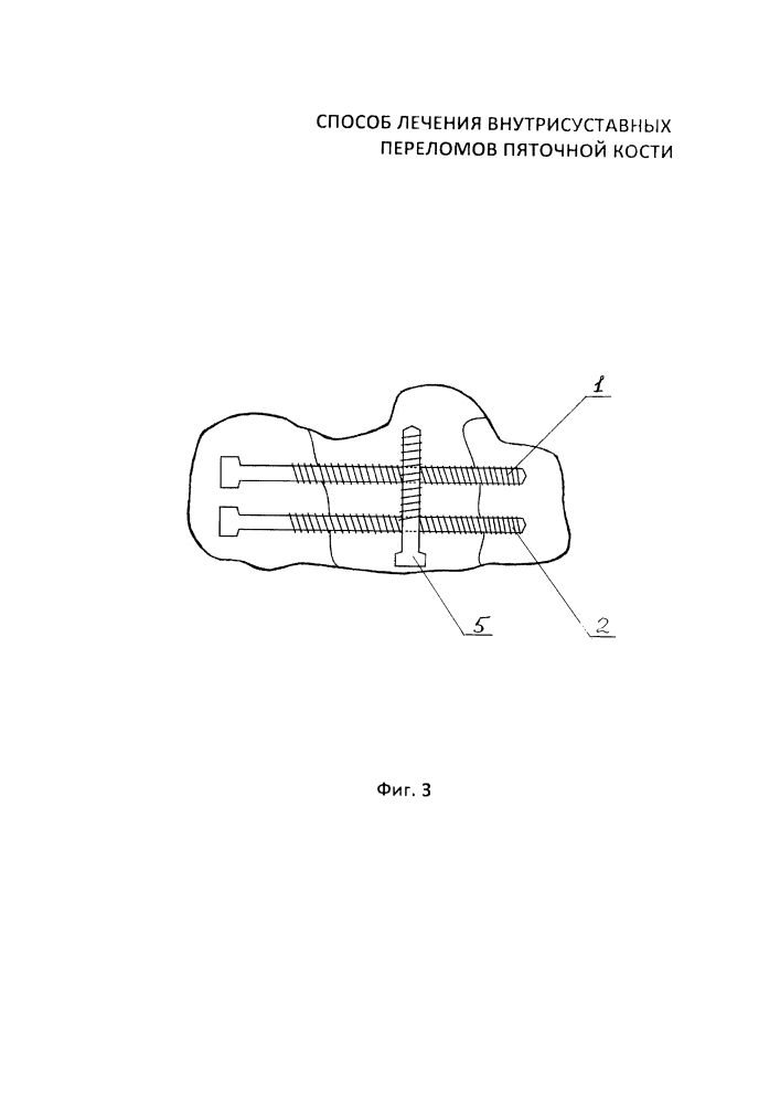 Способ лечения внутрисуставных переломов пяточной кости (патент 2630870)