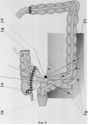 Способ илеоцекоцистопластики (патент 2323688)