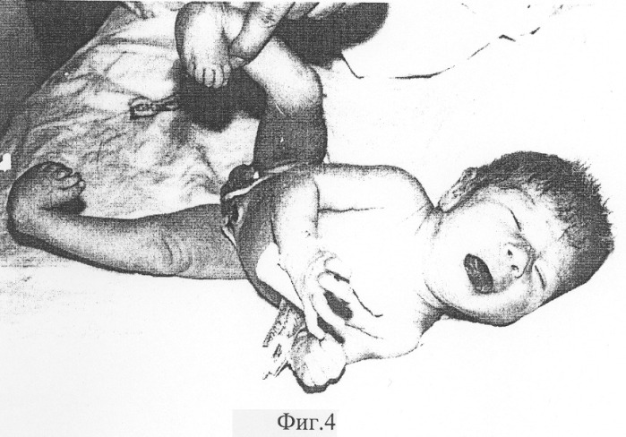 Способ лечения косолапости у детей первого полугодия жизни (патент 2299710)