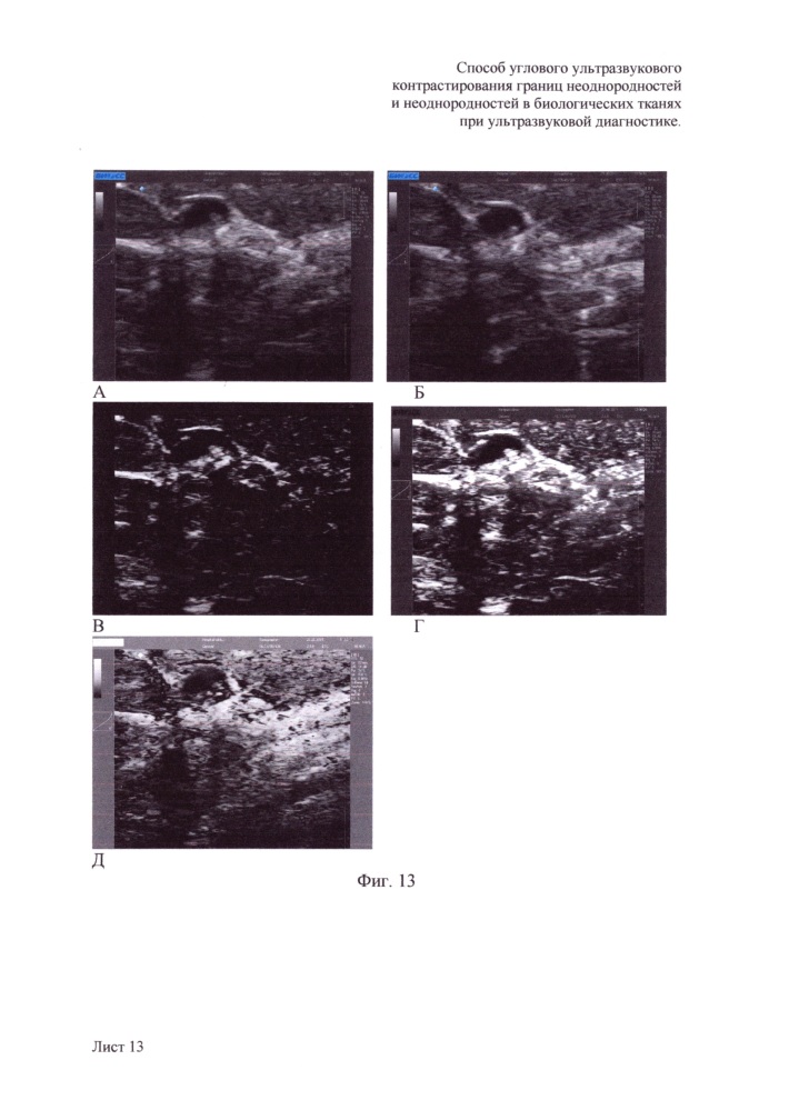 Способ углового ультразвукового контрастирования границ неоднородностей и неоднородностей в биологических тканях при ультразвуковой диагностике (патент 2648880)