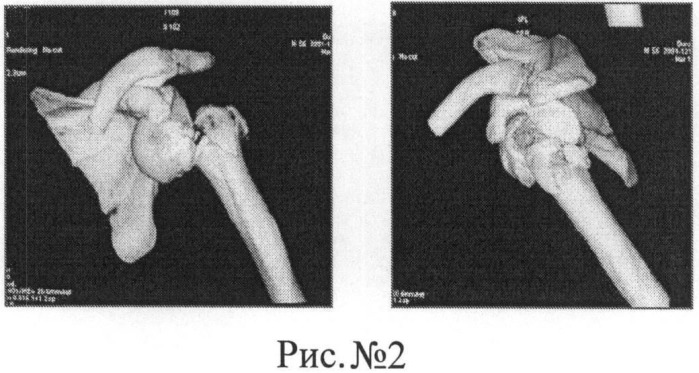 Способ хирургического лечения переломо-вывихов проксимального отдела плечевой кости напряженными спицами (патент 2483688)
