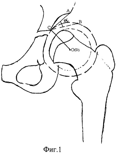 Способ определения угла низведения свода вертлужной впадины при ее коррекции (патент 2441586)
