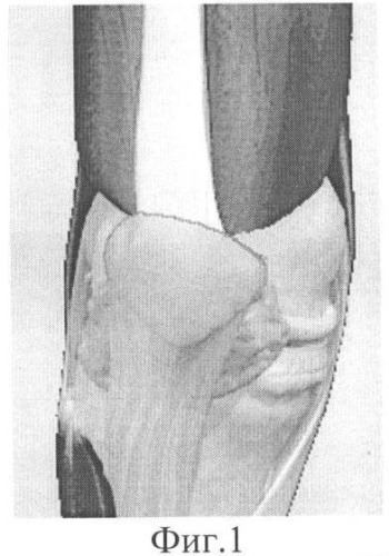 Способ хирургической реинсерции m. vastus medialis obliquus при посттравматической латеральной пателлярной дислокации с использованием артроскопических технологий (патент 2354316)