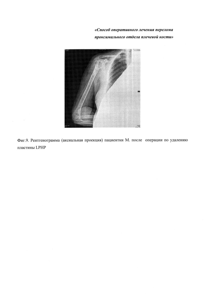 Способ хирургического лечения перелома проксимального отдела плечевой кости (патент 2652573)
