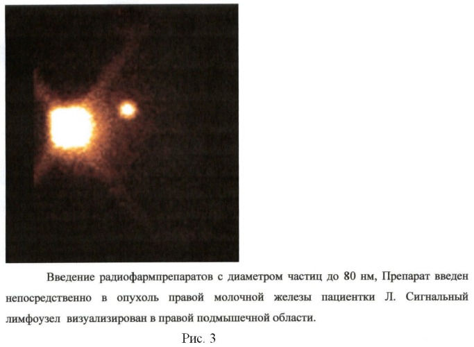Способ определения сигнальных лимфатических узлов у больных рмж с помощью коллоидных рфп с различным диаметром частиц (патент 2469334)
