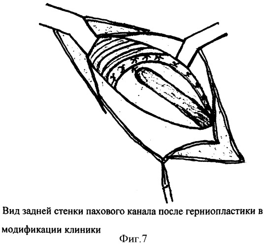 Способ герниопластики при паховых грыжах (патент 2338467)