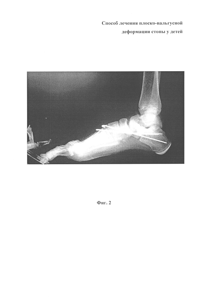 Способ лечения плоско-вальгусной деформации стопы у детей (патент 2602935)
