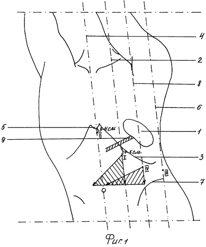 Способ операционного доступа при лапароскопической спленэктомии (патент 2310416)