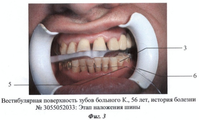 Способ шинирования зубов при пародонтите (патент 2436540)