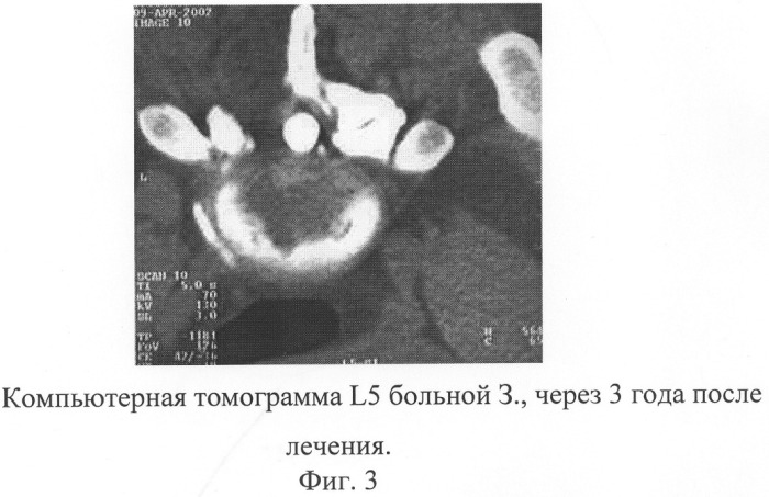 Способ лечения грыжи межпозвонкового диска (патент 2281055)