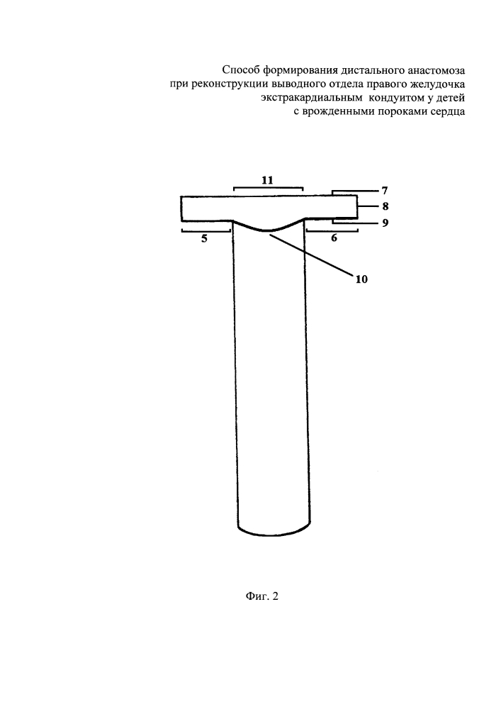 Способ формирования дистального анастомоза при реконструкции выводного отдела правого желудочка экстракардиальным кондуитом у детей с врожденными пороками сердца (патент 2644921)