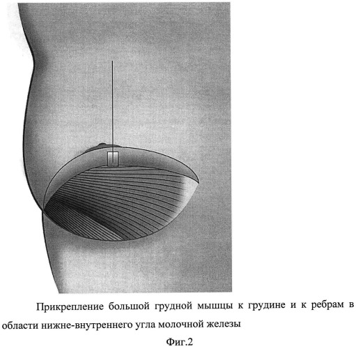 Способ формирования кармана для имплантата в двойственной плоскости при аугментационной маммопластике (патент 2498777)