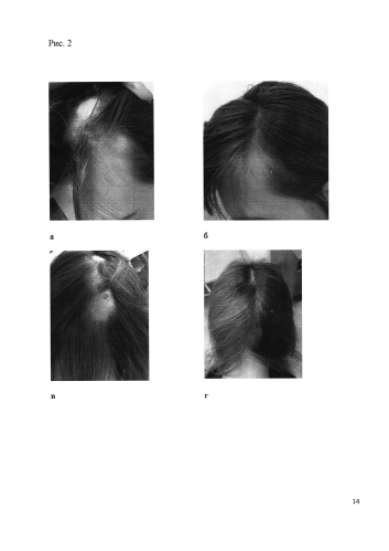 Способ получения средства для лечения нерубцовых алопеций (патент 2583552)