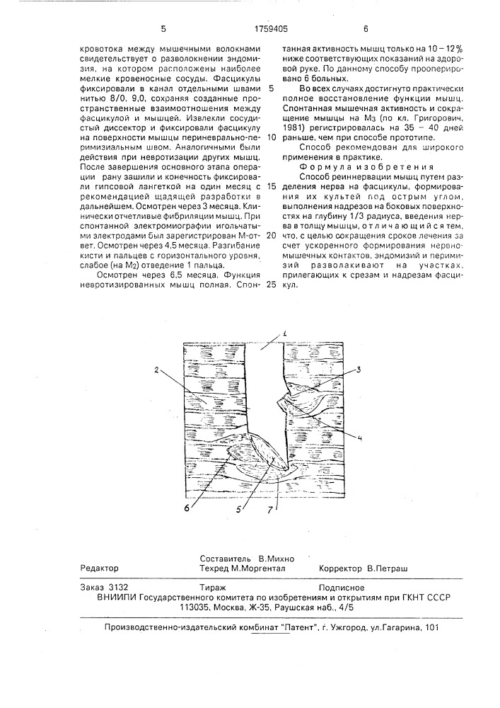 Способ реиннервации мышц (патент 1759405)