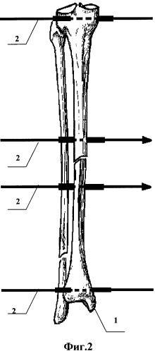 Способ лечения осевых деформаций диафиза костей голени (патент 2446760)
