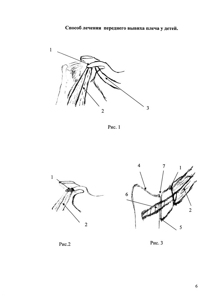 Способ лечения переднего вывиха плеча у детей (патент 2663076)