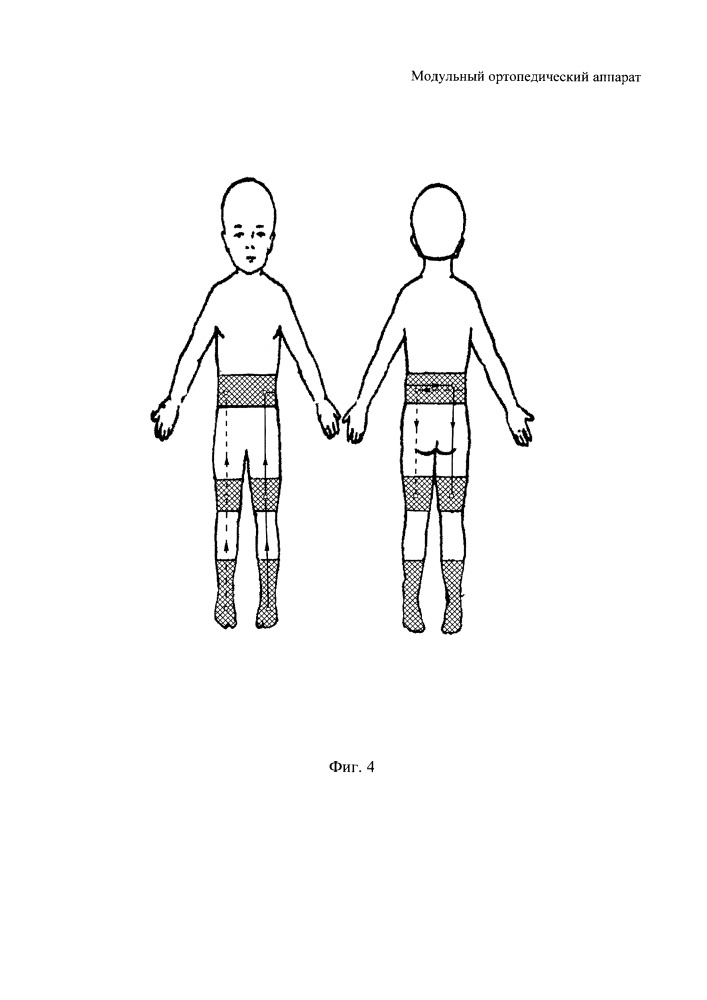 Модульный ортопедический аппарат (патент 2659132)