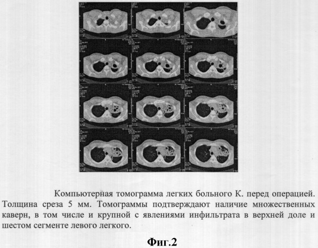 Способ лечения деструктивного туберкулеза легких (патент 2312616)