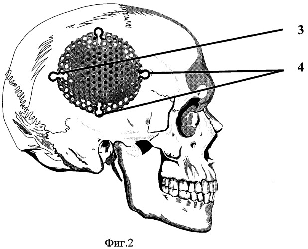 Устройство для закрытия дефектов костей свода черепа (патент 2308909)