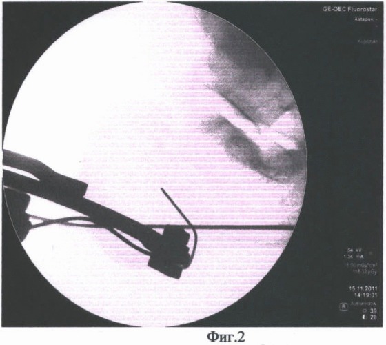 Способ закрытой репозиции переломов пяточной кости (патент 2480178)