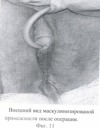Способ маскулинизирующей уретропластики при лечении транссексуализма (патент 2371115)