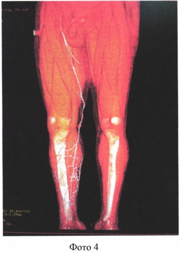 Способ мультиспиральной компьютерной томографии-флебографии вен нижних конечностей (патент 2548139)