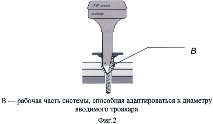 Способ безопасного доступа в брюшную полость у пациентов с послеоперационными внутрибрюшными осложнениями (патент 2472463)