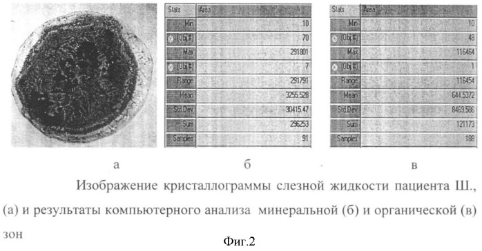 Способ дифференциальной диагностики инфекционно-воспалительных осложнений при травме глаза (патент 2356053)